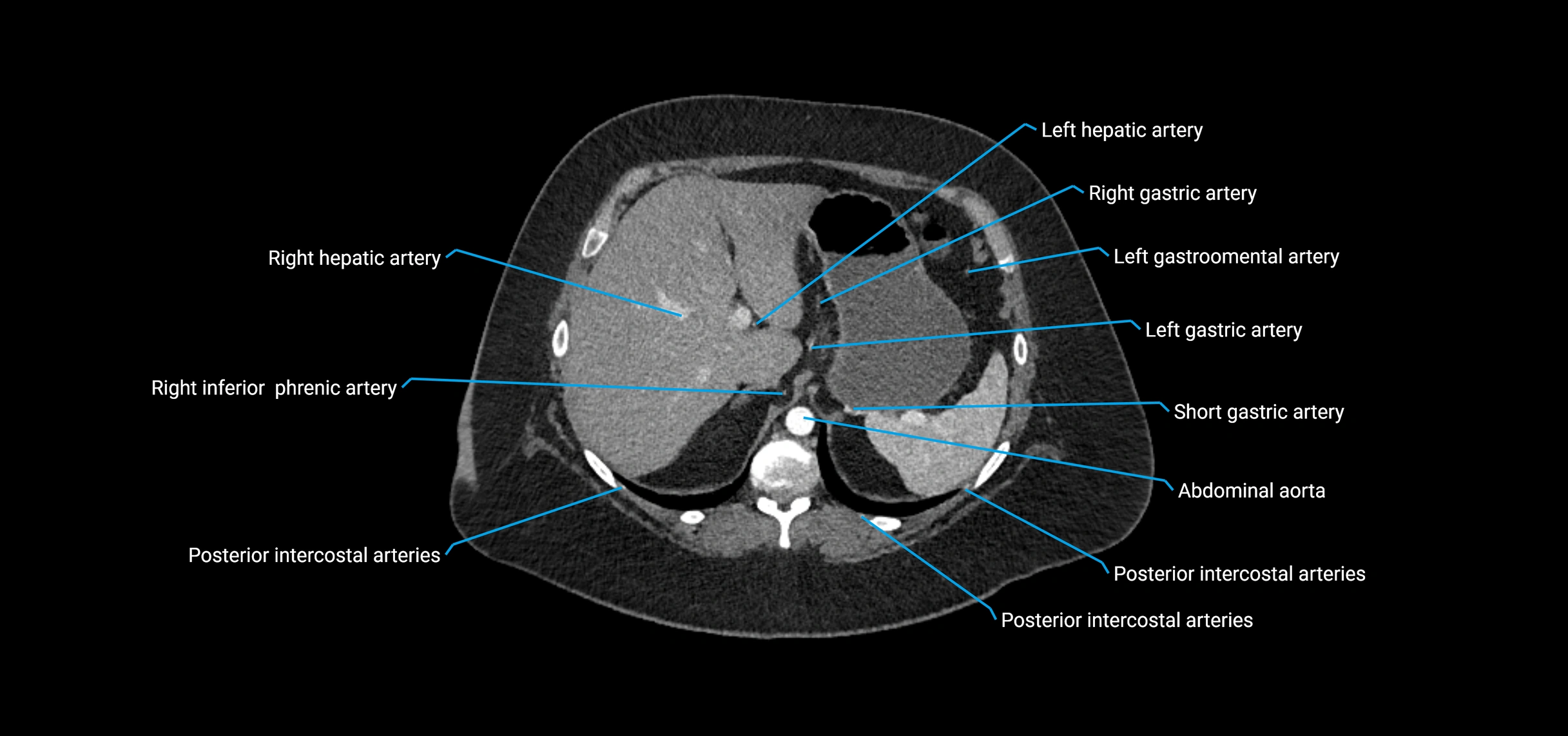 CTA abdomen axial cross sectional anatomy labelled image_38 (2).webp